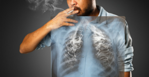 Secondo il dottor Mozzi il fumo non è la sola causa dei tumori ai pomoni