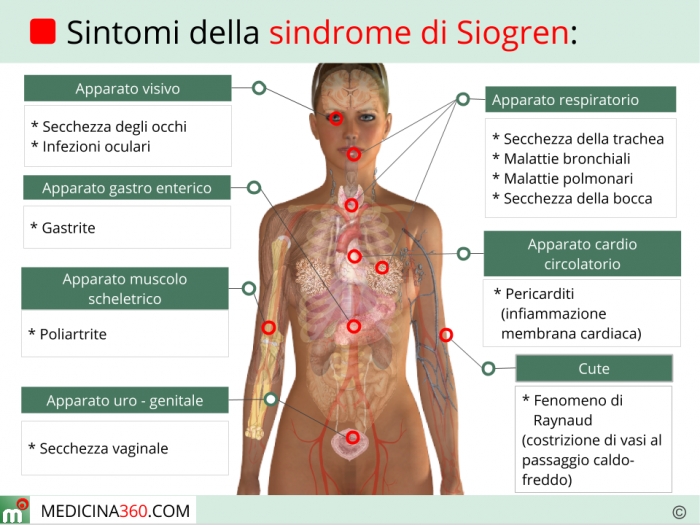 sintomi-sindrome-di-sjogren_700x525