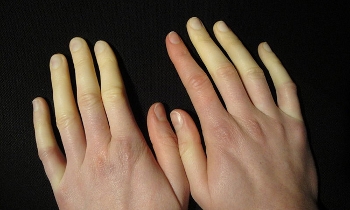 Le mani il sintomo tipico della patologia